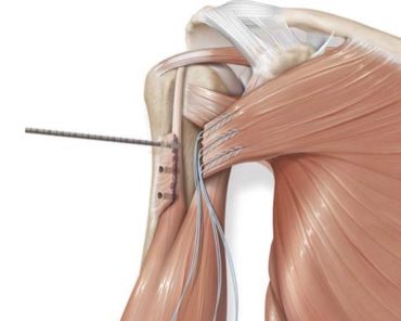 expertise-pectoralis-major-tendon-repair-barden-orthopedics